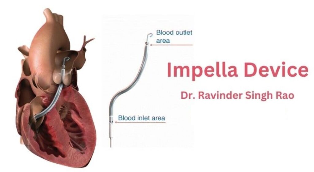 Impella-Device-Impella-Angioplasty