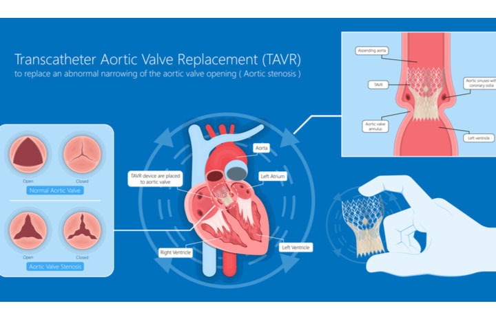aortic-valve-replacement-and-implantation